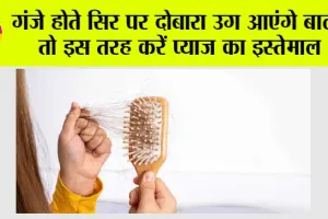 Hair fall Remedies: गंजे होते सिर पर दोबारा उग आएंगे बाल! बस इस तरह करें प्याज का इस्तेमाल