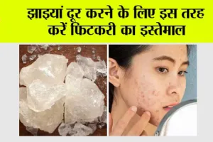 Fitkari for Dark Spots: झाइयां दूर करने के लिए इस तरह करें फिटकरी का इस्तेमाल