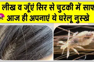 Head Lice Treatment: सिर की जूँओं से हैं परेशान ? इन घरेलू नुस्खों से छुटकारा पाना है आसान