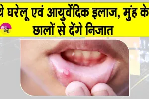 Mouth Ulcers Treatment: मुंह के छालों की वजह से खाना, पीना व बोलना भी हो गया दूभर, जानें  घरेलू उपाय