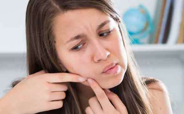 ये घरेलू उपाय अपनाएं, पाएं मुहांसों से मुक्त दमकता चेहरा