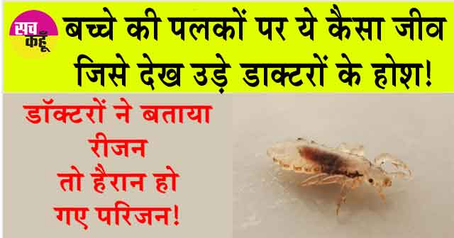 Eyelash lice: बच्चे की पलकों पर ये कैसा जीव जिसे देख उड़े डाक्टरों के होश!