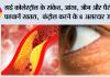 High Cholesterol Symptoms: हाई कोलेस्ट्रॉल के संकेत, आंख, जीभ और पैरों से पहचानें खतरा,  कंट्रोल करने के 6 असरदार उपाय
