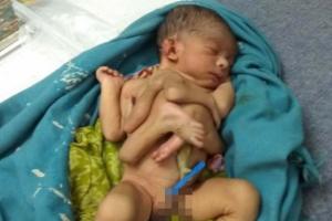 मुजफ्फरपुर में चार हाथ-पैर वाले  बच्चे का जन्म, देखने को उमड़ी भीड़