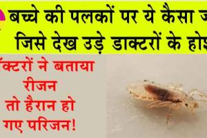 Eyelash lice: बच्चे की पलकों पर ये कैसा जीव जिसे देख उड़े डाक्टरों के होश!