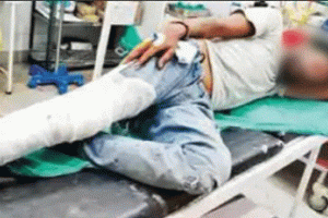मोबाईल छीन कर भाग रहे लूटेरे हुए सड़क हादसे का शिकार