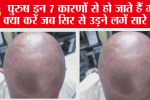 Hair Care Tips: इन कारणों से पुरुष होने लगते हैं तेजी से गंजे, समय रहते कर लें केयर
