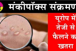 Mpox Virus in Europe: यूरोप में तेजी से एमपॉक्स वायरस के फैलने का खतरा!
