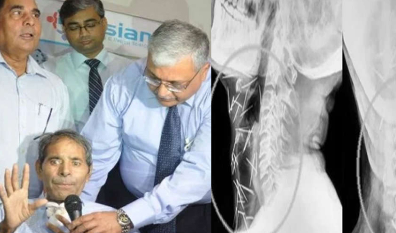 Doctors, Pins, Throat, Surgery, Needle, Successful, Haryana