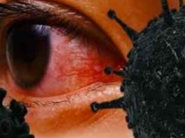 अब ब्लैक फंगस बढ़ा रहा चिंता, मुंबई में तीन बच्चों की निकालनी पड़ी आँख Black-fungus-sirsa sachkahoon