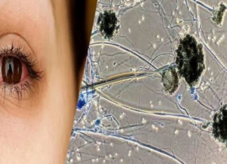 black fungus in Sirsa