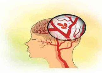 Brain stroke sachkahoon