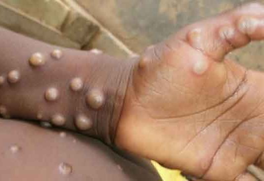 Monkeypox