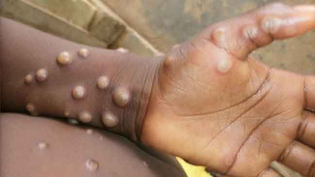 Monkeypox in UK