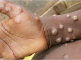 Monkeypox Virus