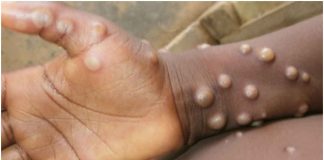 Monkeypox Virus