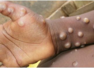 Monkeypox Virus