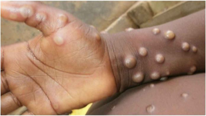 Monkeypox Virus