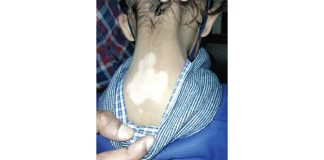 Vitiligo Disease