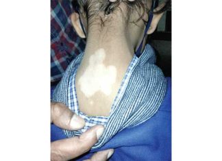 Vitiligo Disease