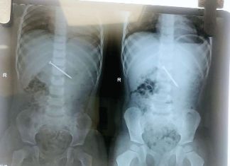 कील निगलने वाले तीन साल के बालक का जन सेवा हॉस्पिटल में हुआ सफल उपचार rajasthan