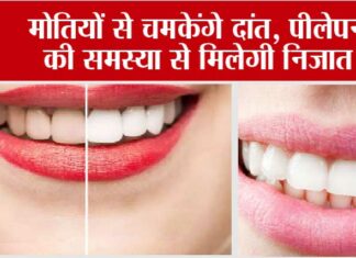 Yellow Teeth Home Remedies