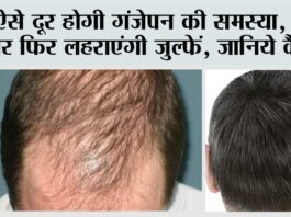 Hair Fall