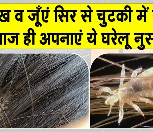 Head Lice Treatment: सिर की जूँओं से हैं परेशान ? इन घरेलू नुस्खों से छुटकारा पाना है आसान Head Lice Treatment
