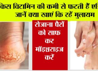 Cracked Heels Cause: किस विटामिन की कमी से फटती हैं एड़ियां? जानें क्या खाएं कि रहें मुलायम Cracked Heels Cause